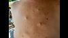 Extreme Cyst U0026 Pimple Explosion Under Pressure
