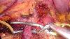 Laparoscopic Distal Pancreatectomy For Large Spn Full Length Procedure