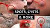 Spot Popping Cysts Pimples U0026 More 2023 Compilation Part 2 Tiktok